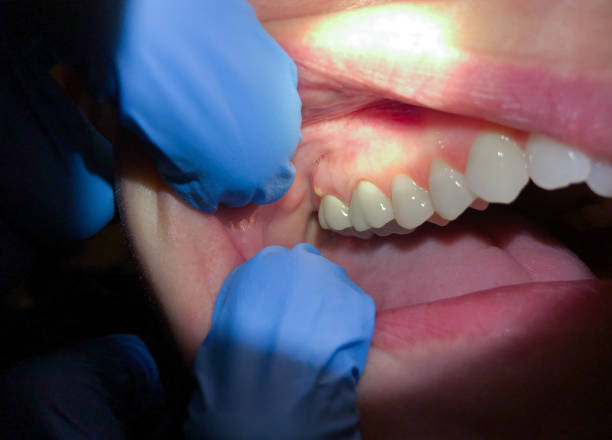 Best Emergency Denture Repair in Glenolden, PA